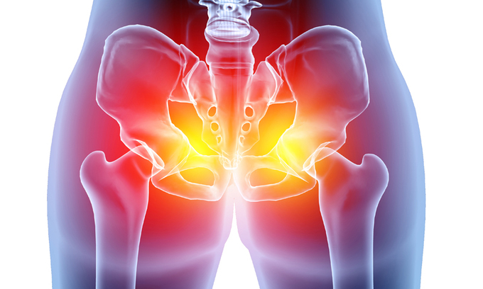 필라테스·고관절 스트레칭 후 사타구니 통증 지속된다면… 젊은 여성 위협하는 ‘고관절 이형성증’